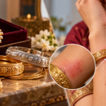 Jewellery and contact dermatitis skin reaction